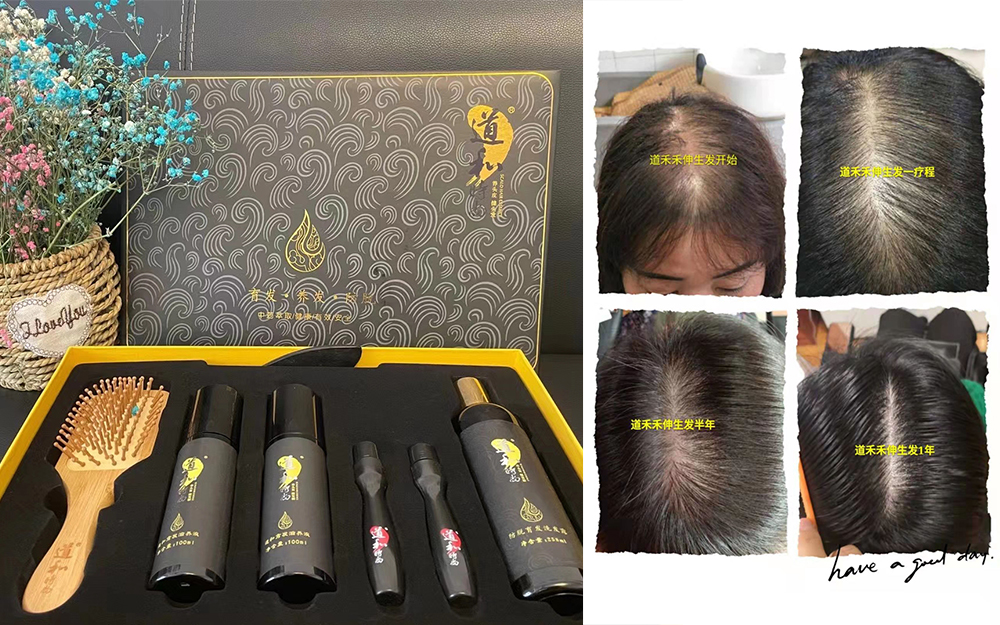 男性脫發(fā)的種類(lèi)與原因